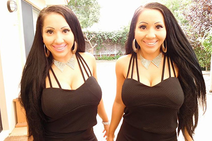 Самые одинаковые близнецы в мире потратили 250 тысяч долларов на пластику