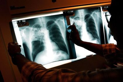 Россиянам указали на рост заболеваемости туберкулезом на Украине