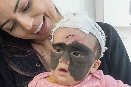 Мама американской «девочки-бэтмена» показала дочь после операции в России
