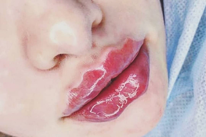 Аномальные губы стали трендом у российских женщин