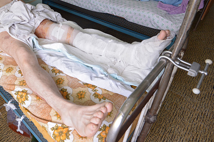 В российской больнице инвалида заставили снимать гипс кусачками