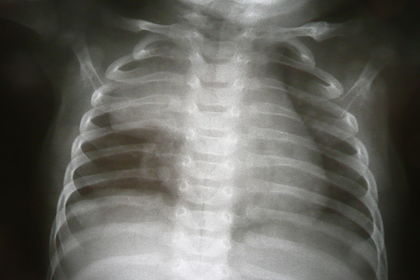 Вилочковая железа на рентгенограмме