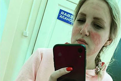 Российская медсестра показала тяжелые ожоги после ношения костюма химзащиты