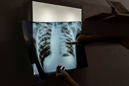 Предсказана массовая гибель от туберкулеза из-за карантина