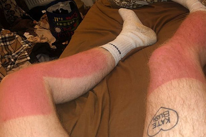 Солнечные ожоги странной формы на ногах мужчины подняли на смех в сети