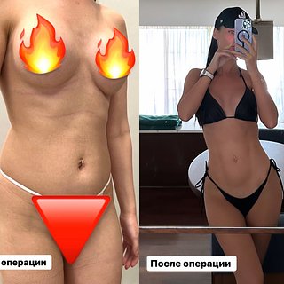 Жена звездного хирурга Хайдарова показала фигуру до и после пластики
