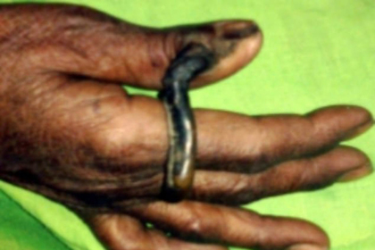 Женщина пять лет растила на пальце огромный рог