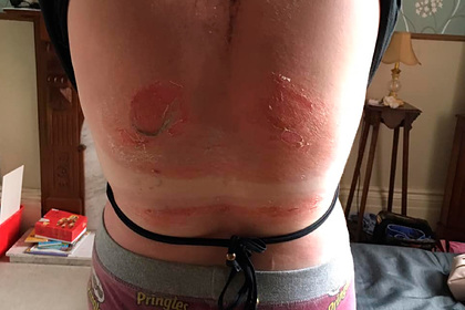 Волдыри на спине девушки после пляжного отдыха перепугали пользователей сети
