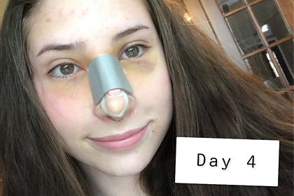Затравленная из-за формы носа школьница потратила сотни тысяч рублей на пластику