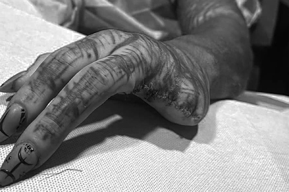 Объявивший себя «черным пришельцем» мужчина удалил два здоровых пальца на руке